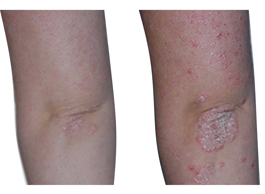 Psoriasis Eczeem Vitiligo behandeling USB-lamp